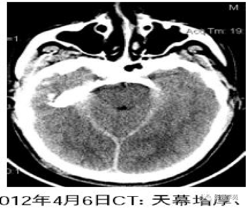 影像PPT - 肥厚性硬脑膜炎-5 影像PPT - 肥厚性硬脑膜炎-5