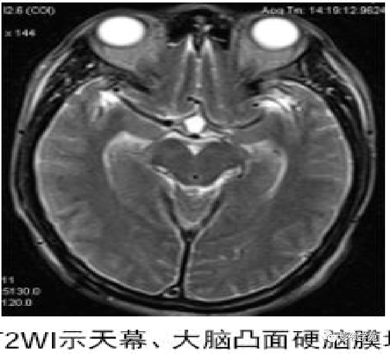 影像PPT - 肥厚性硬脑膜炎-7 影像PPT - 肥厚性硬脑膜炎-7