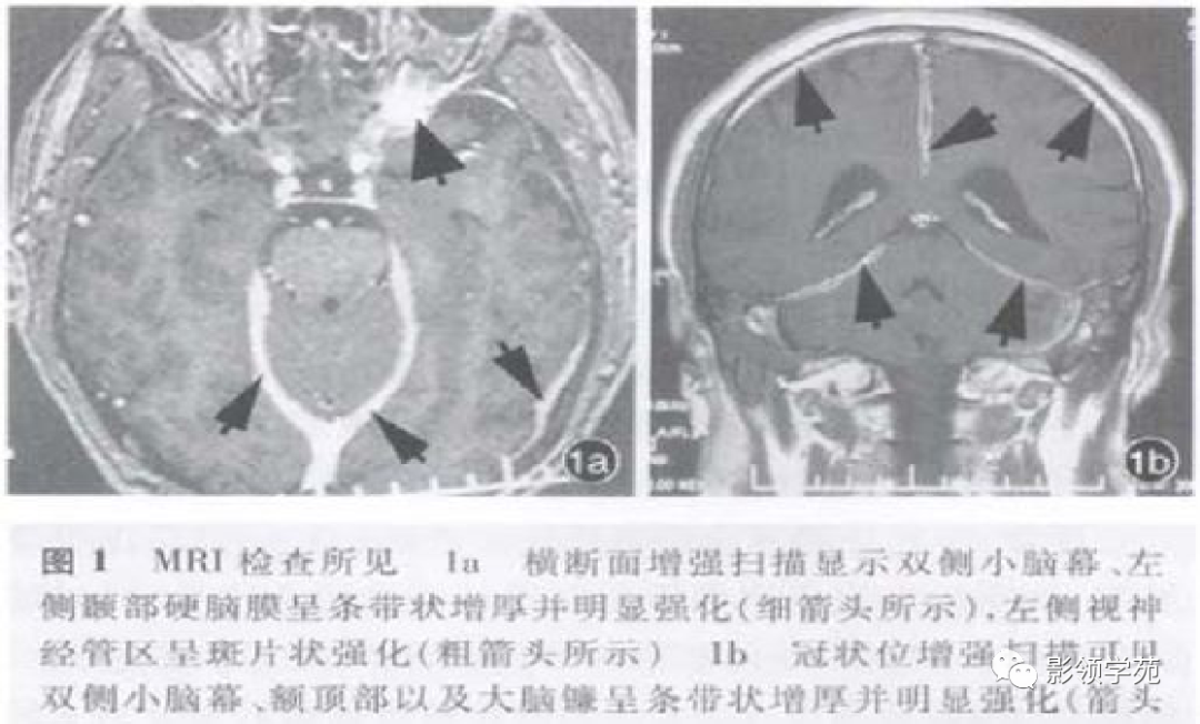 影像PPT - 肥厚性硬脑膜炎-8 影像PPT - 肥厚性硬脑膜炎-8