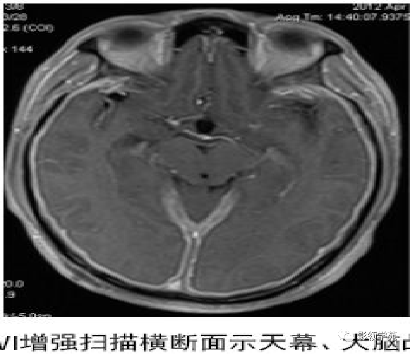 影像PPT - 肥厚性硬脑膜炎-9 影像PPT - 肥厚性硬脑膜炎-9