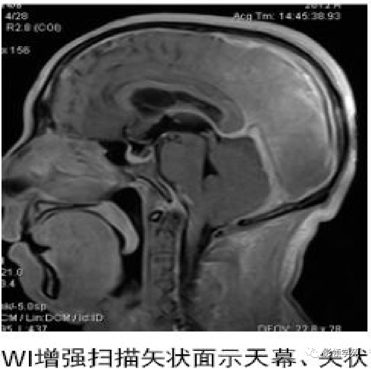 影像PPT - 肥厚性硬脑膜炎-10 影像PPT - 肥厚性硬脑膜炎-10