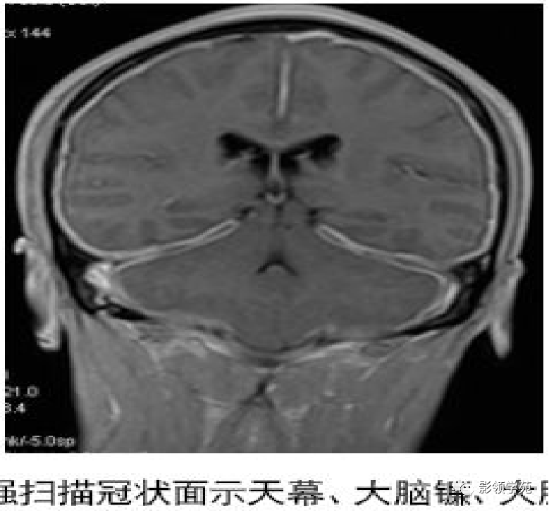 影像PPT - 肥厚性硬脑膜炎-11 影像PPT - 肥厚性硬脑膜炎-11