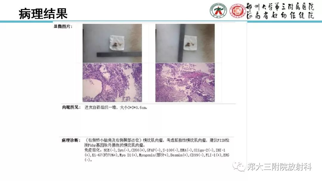 影像PPT - 【病例】胚胎性横纹肌肉瘤1例CT及MR影像-14