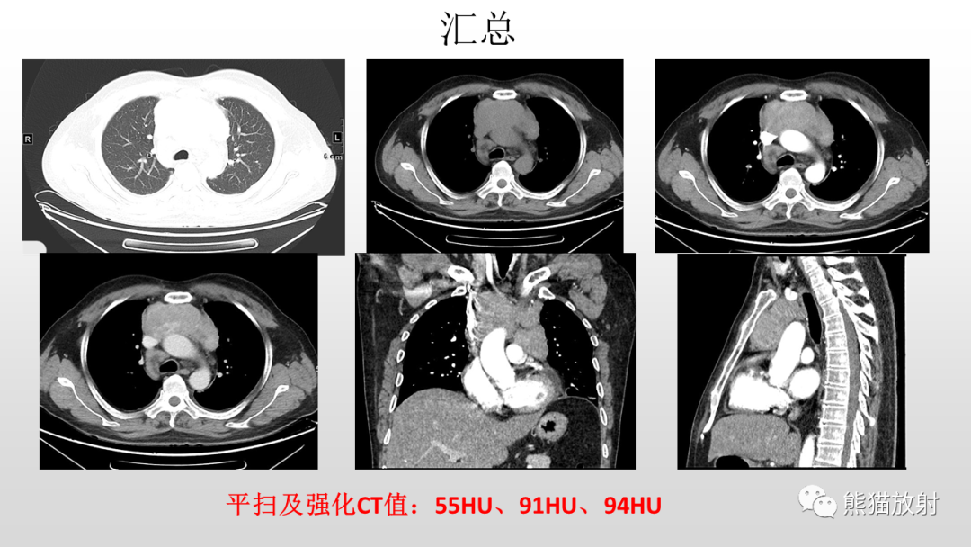 影像PPT - 【病例】胸腺类癌2例CT影像-7