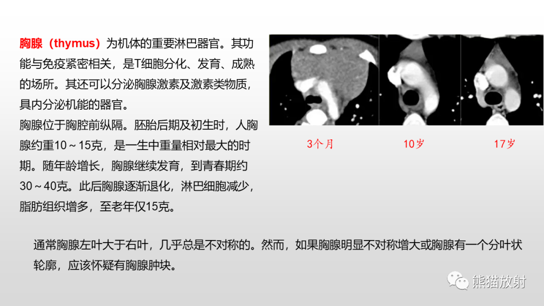 影像PPT - 【病例】胸腺类癌2例CT影像-19