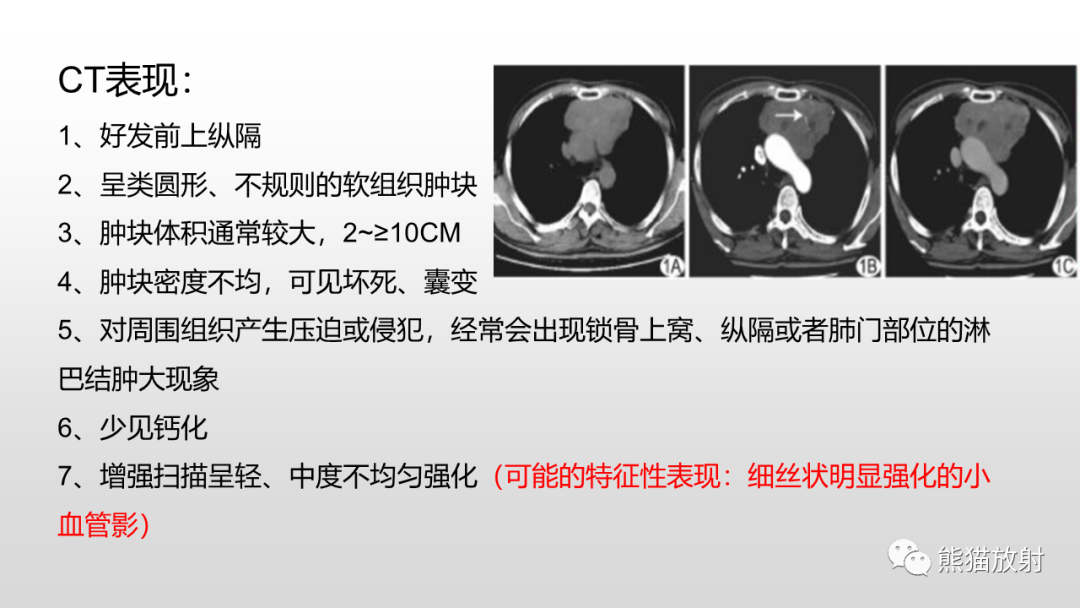 影像PPT - 【病例】胸腺类癌2例CT影像-22
