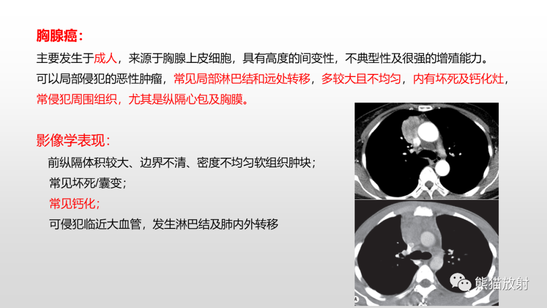 影像PPT - 【病例】胸腺类癌2例CT影像-25