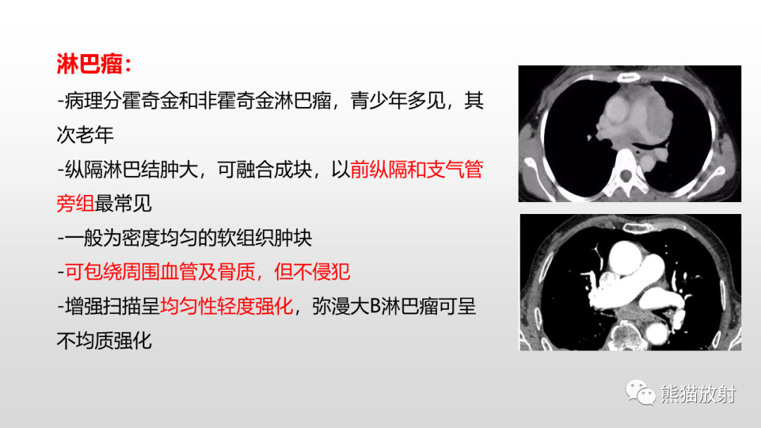 影像PPT - 【病例】胸腺类癌2例CT影像-26