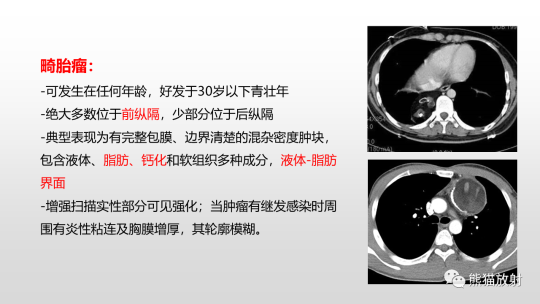 影像PPT - 【病例】胸腺类癌2例CT影像-27