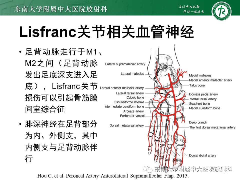 影像PPT - 【病例】跖跗关节损伤/Lisfranc关节损伤1例X线及CT-9