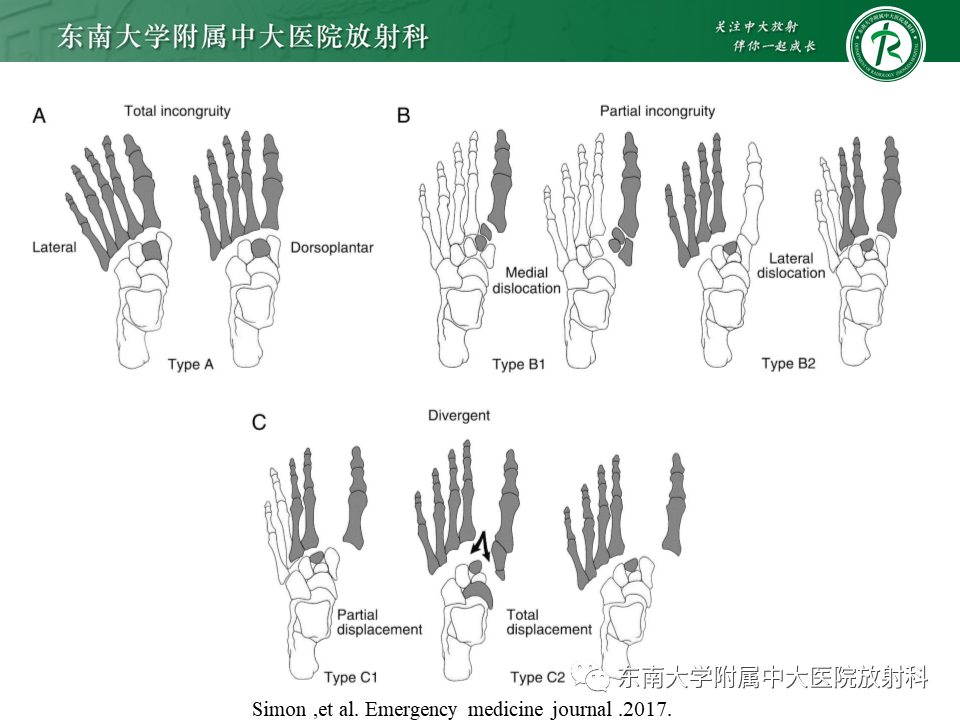 影像PPT - 【病例】跖跗关节损伤/Lisfranc关节损伤1例X线及CT-13