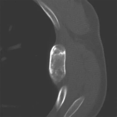 影像PPT - 肋骨病变CT总结-20 影像PPT - 肋骨病变CT总结-20