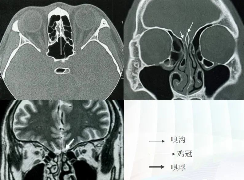 影像PPT - 颅底影像解剖及病变分析-5 影像PPT - 颅底影像解剖及病变分析-5