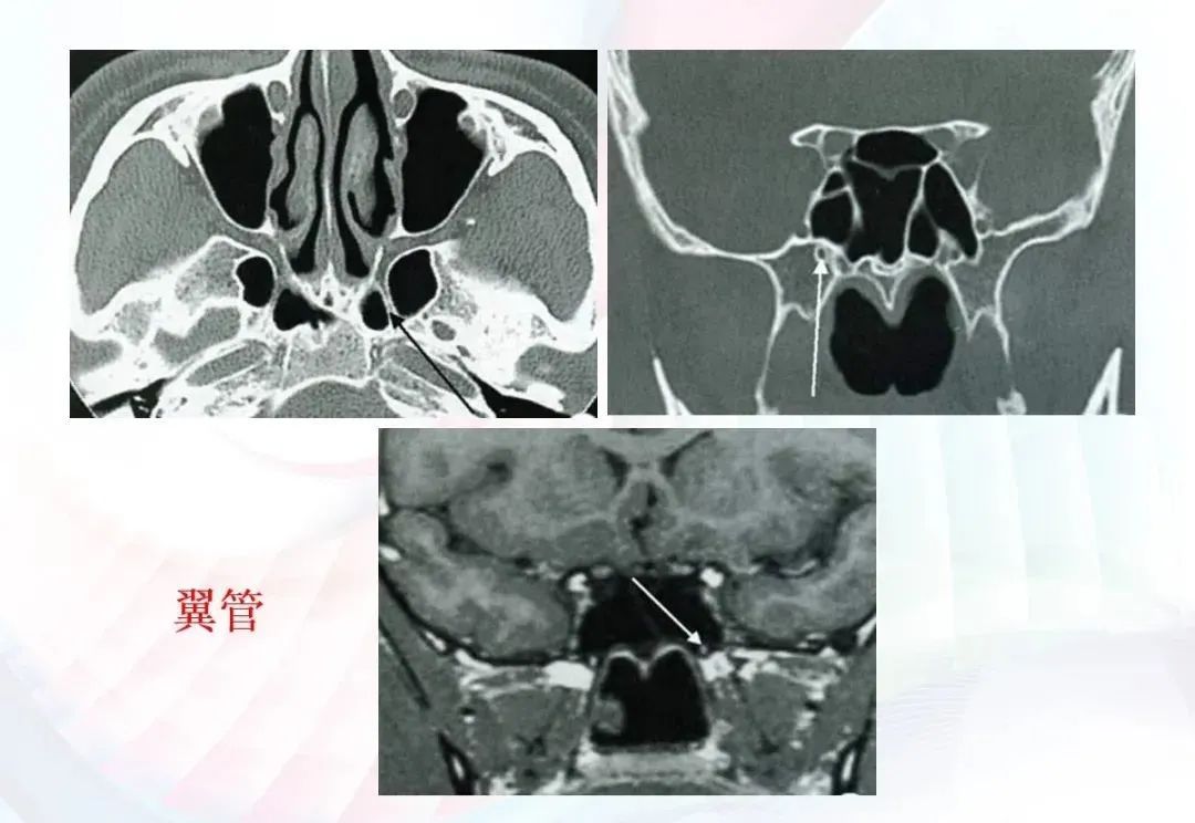 影像PPT - 颅底影像解剖及病变分析-14 影像PPT - 颅底影像解剖及病变分析-14