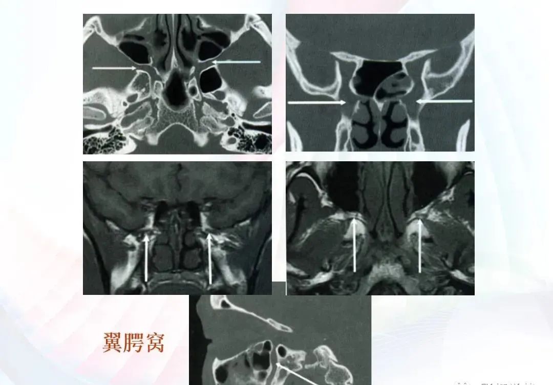 影像PPT - 颅底影像解剖及病变分析-15 影像PPT - 颅底影像解剖及病变分析-15