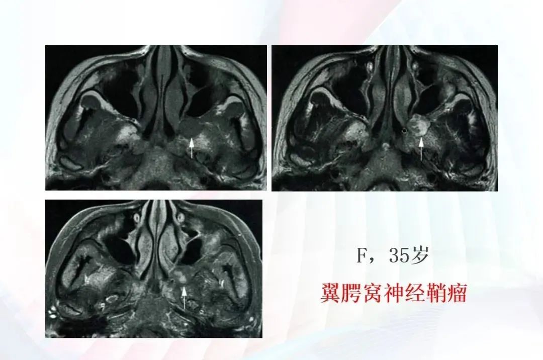 影像PPT - 颅底影像解剖及病变分析-16 影像PPT - 颅底影像解剖及病变分析-16