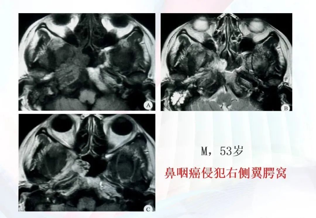 影像PPT - 颅底影像解剖及病变分析-17 影像PPT - 颅底影像解剖及病变分析-17