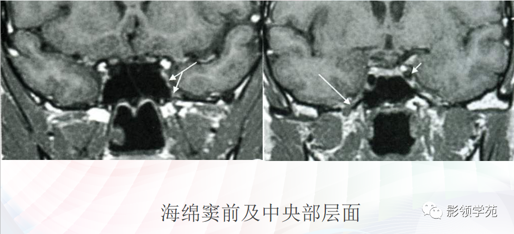 影像PPT - 颅底影像解剖及病变分析-19 影像PPT - 颅底影像解剖及病变分析-19
