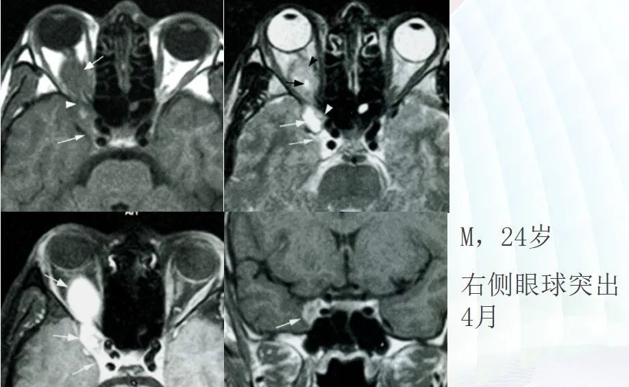 影像PPT - 颅底影像解剖及病变分析-21 影像PPT - 颅底影像解剖及病变分析-21