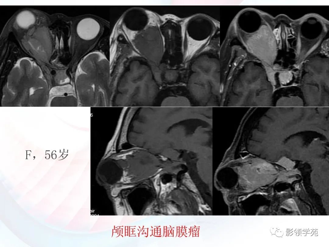 影像PPT - 颅底影像解剖及病变分析-22 影像PPT - 颅底影像解剖及病变分析-22