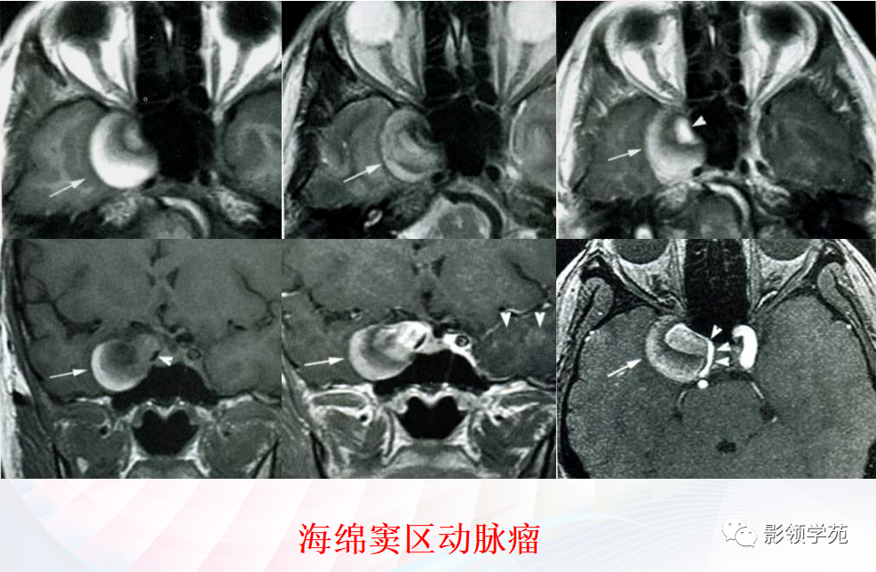 影像PPT - 颅底影像解剖及病变分析-24 影像PPT - 颅底影像解剖及病变分析-24