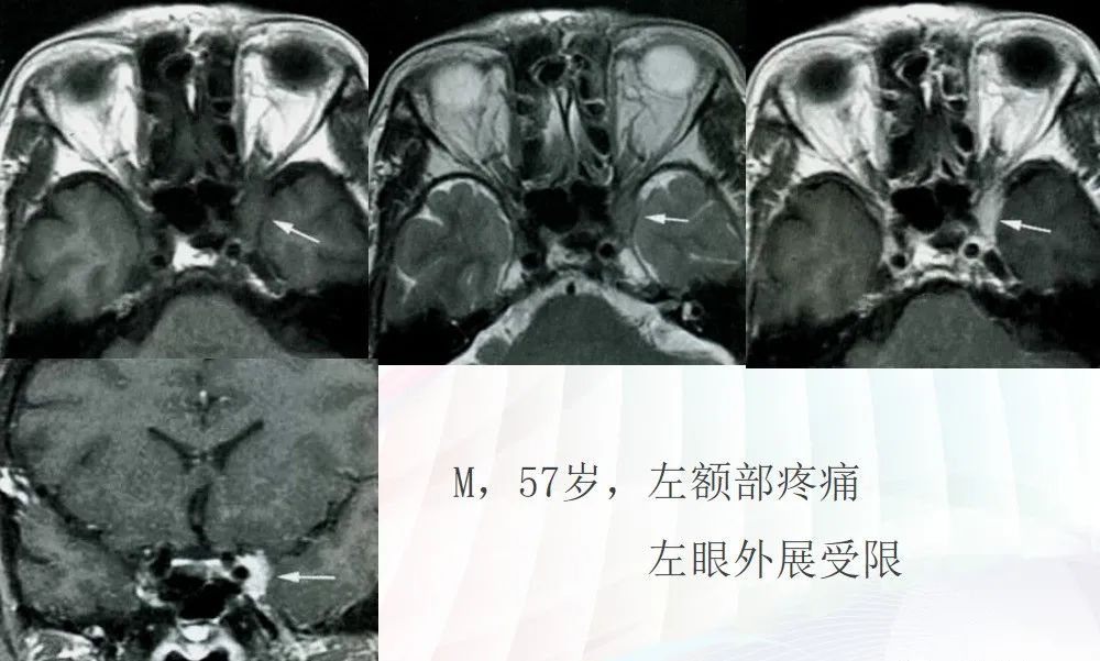影像PPT - 颅底影像解剖及病变分析-25 影像PPT - 颅底影像解剖及病变分析-25
