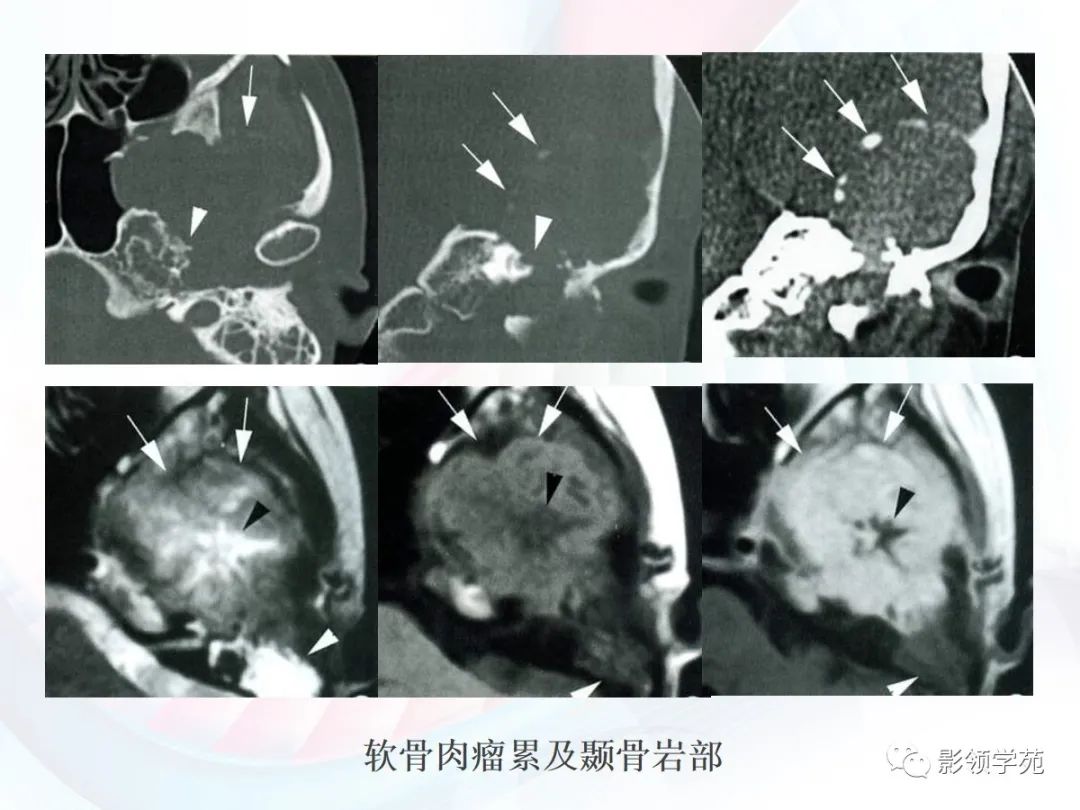 影像PPT - 颅底影像解剖及病变分析-26 影像PPT - 颅底影像解剖及病变分析-26
