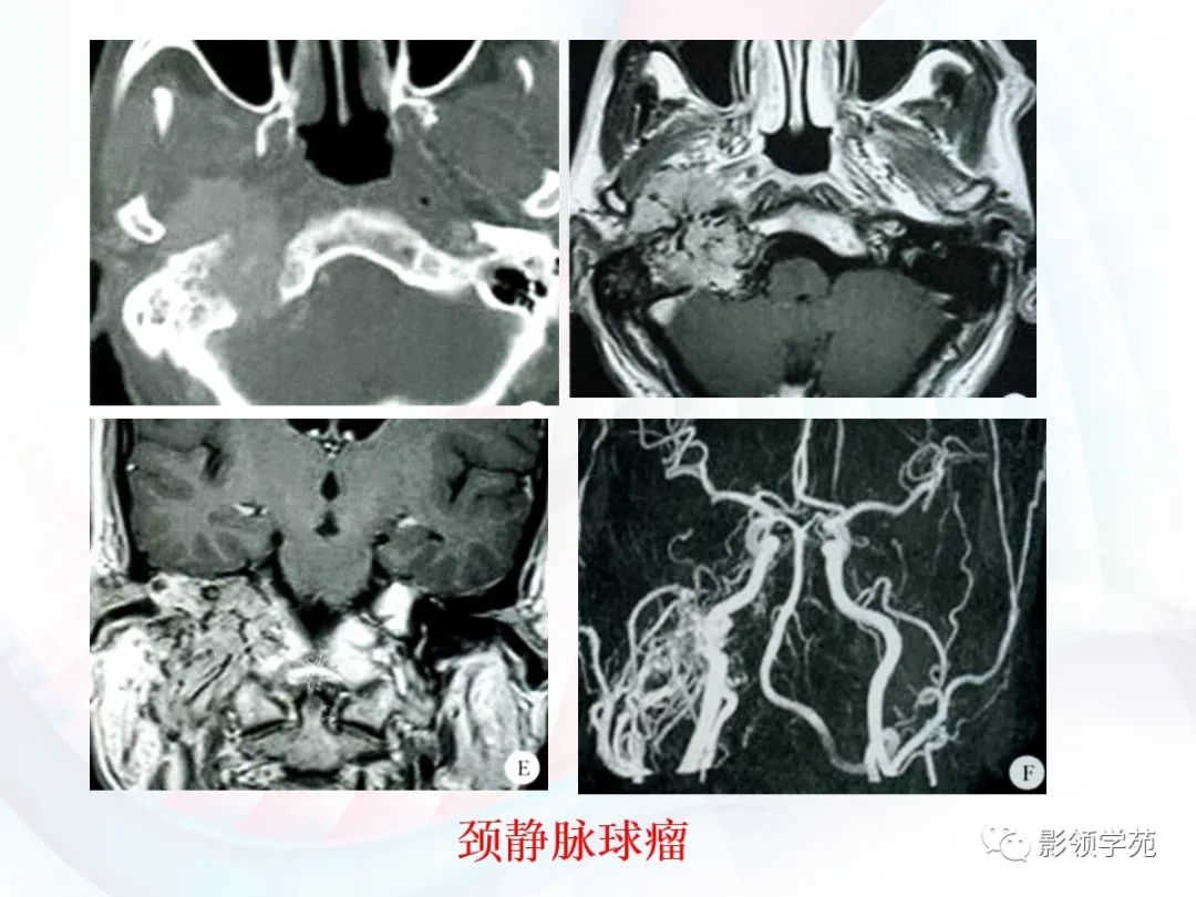 影像PPT - 颅底影像解剖及病变分析-29 影像PPT - 颅底影像解剖及病变分析-29