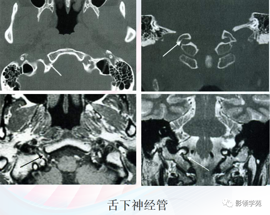 影像PPT - 颅底影像解剖及病变分析-31 影像PPT - 颅底影像解剖及病变分析-31