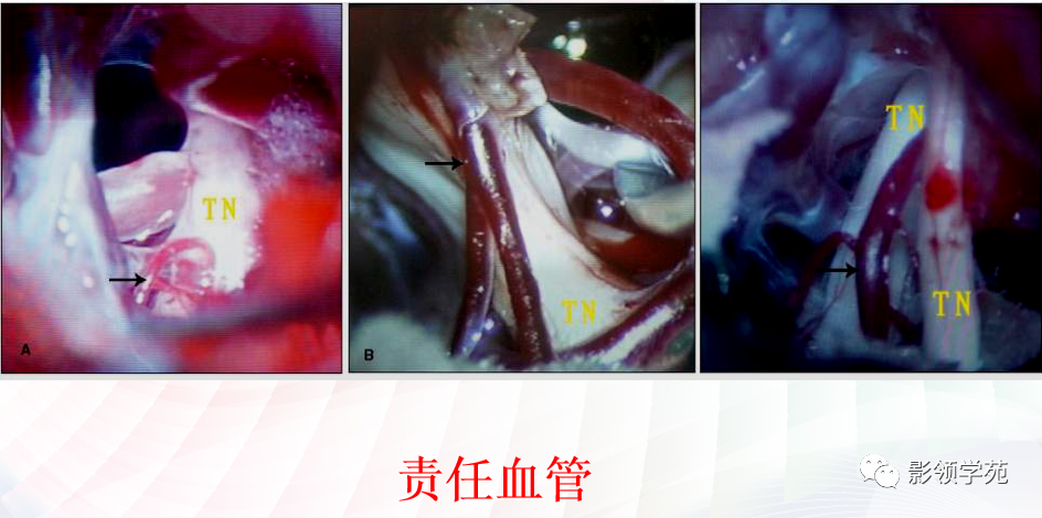 影像PPT - 颅底影像解剖及病变分析-39 影像PPT - 颅底影像解剖及病变分析-39
