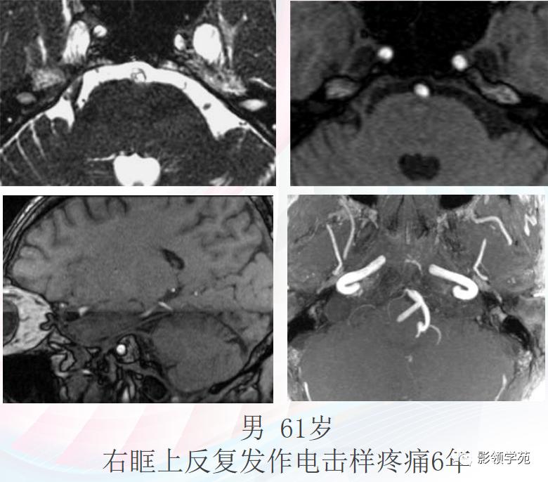 影像PPT - 颅底影像解剖及病变分析-42 影像PPT - 颅底影像解剖及病变分析-42