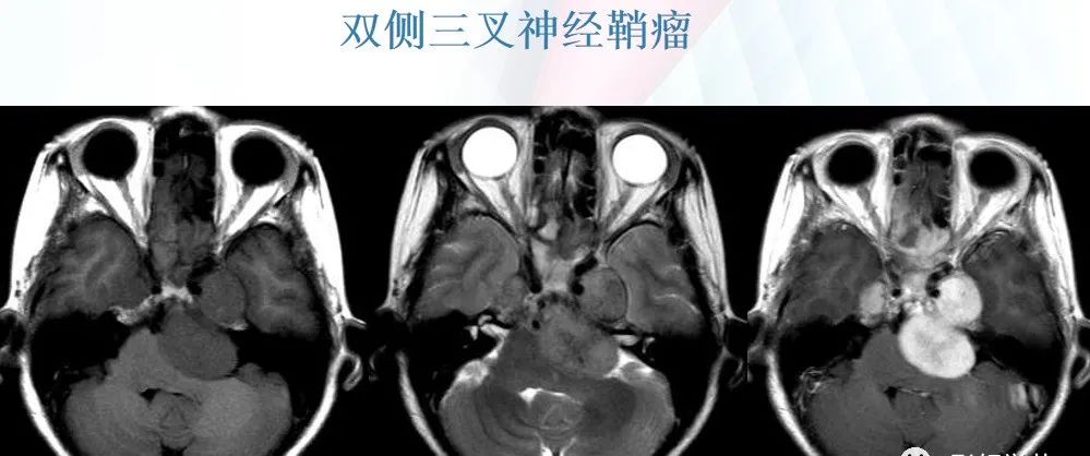 影像PPT - 颅底影像解剖及病变分析-1 影像PPT - 颅底影像解剖及病变分析-1