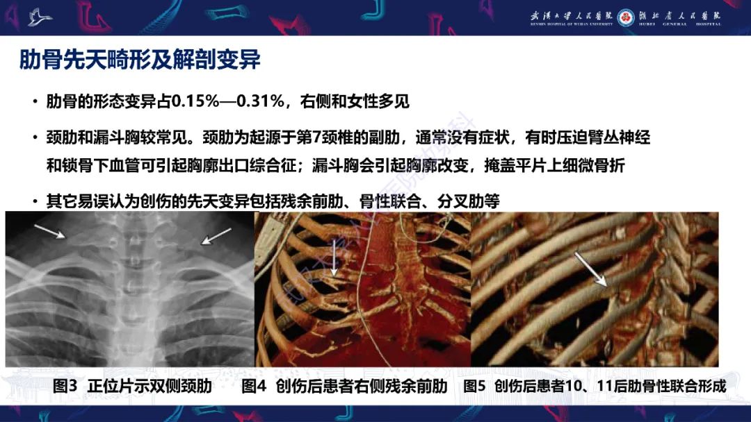 影像PPT - 【PPT】肋骨病变影像诊断-6