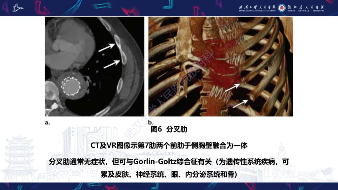 影像PPT - 【PPT】肋骨病变影像诊断-7