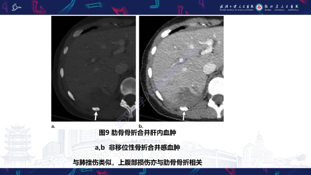 影像PPT - 【PPT】肋骨病变影像诊断-10
