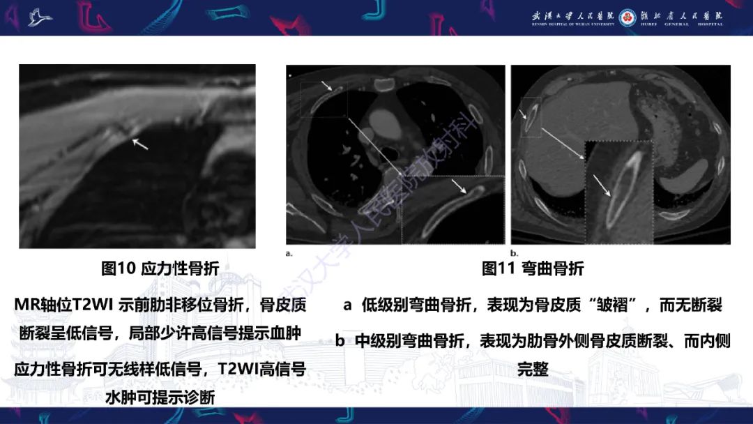 影像PPT - 【PPT】肋骨病变影像诊断-12