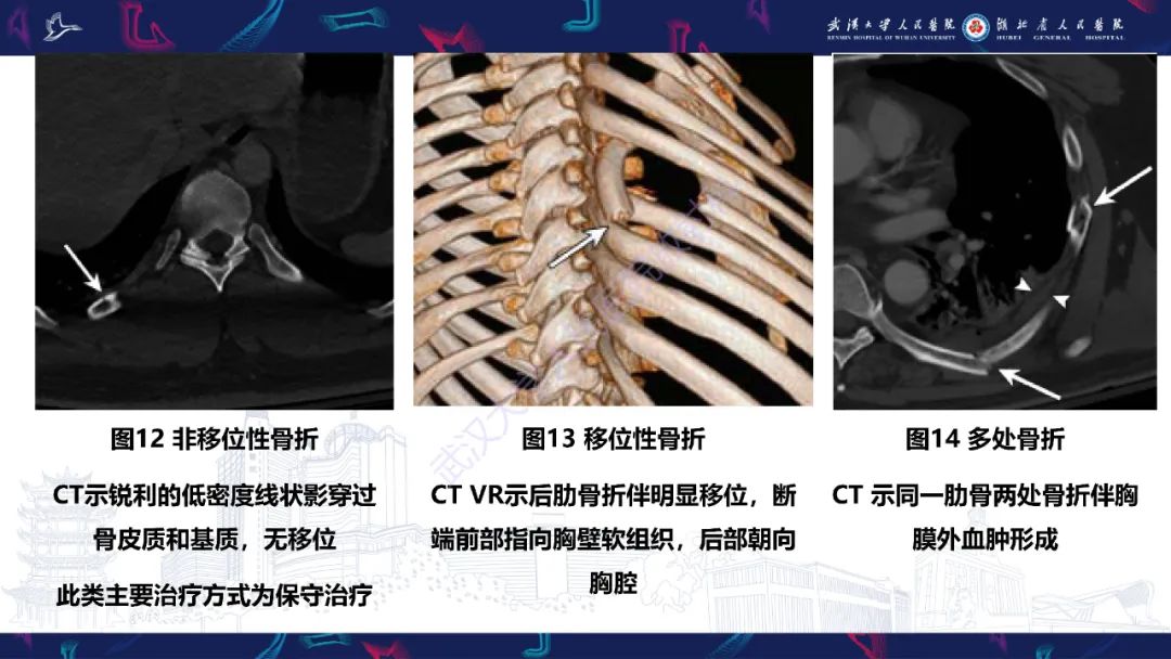 影像PPT - 【PPT】肋骨病变影像诊断-13