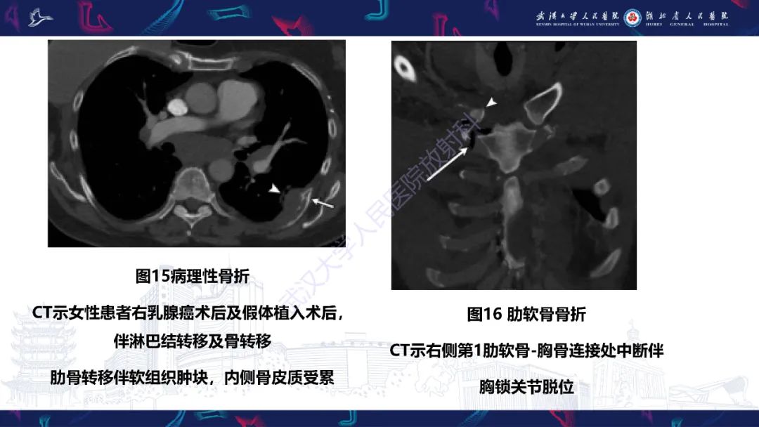 影像PPT - 【PPT】肋骨病变影像诊断-15