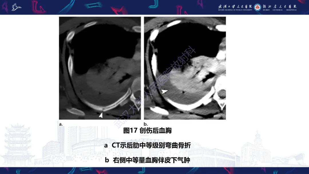 影像PPT - 【PPT】肋骨病变影像诊断-17