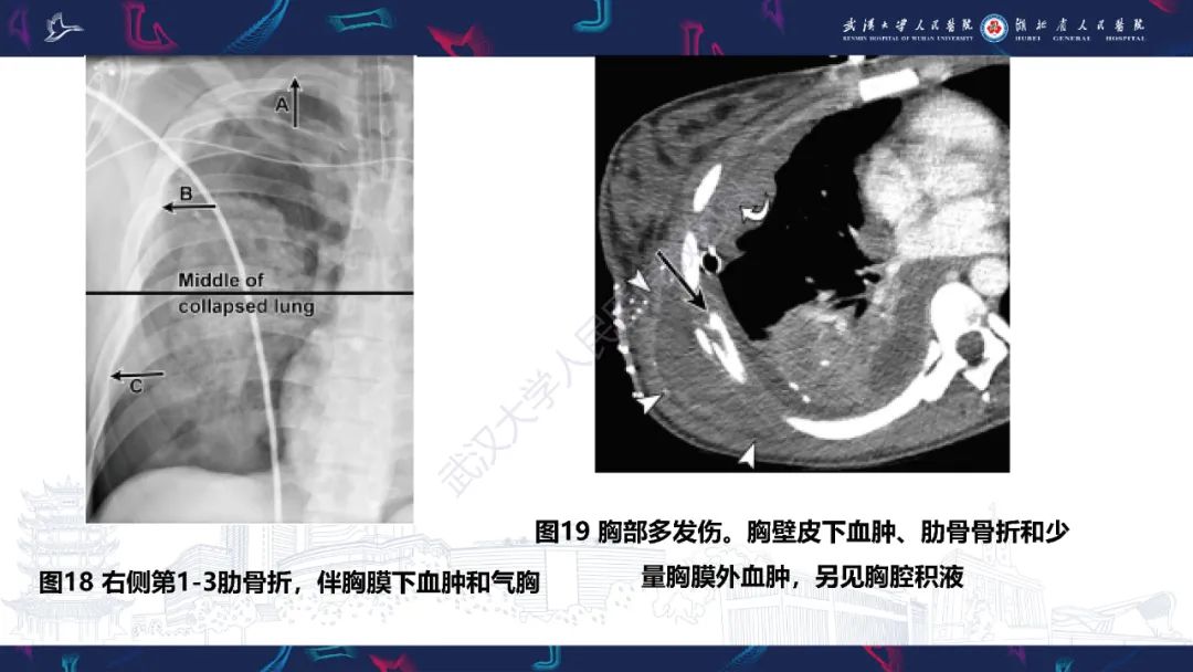 影像PPT - 【PPT】肋骨病变影像诊断-18
