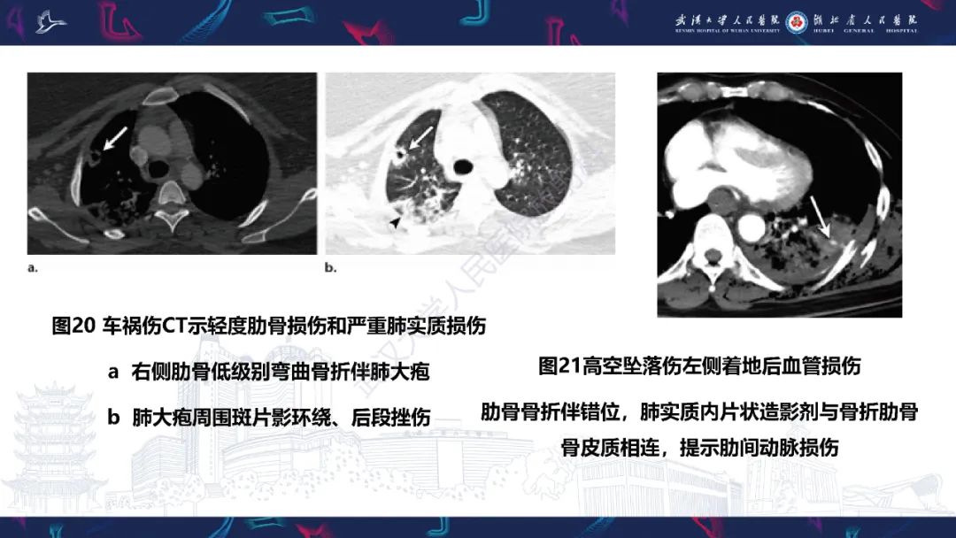 影像PPT - 【PPT】肋骨病变影像诊断-19