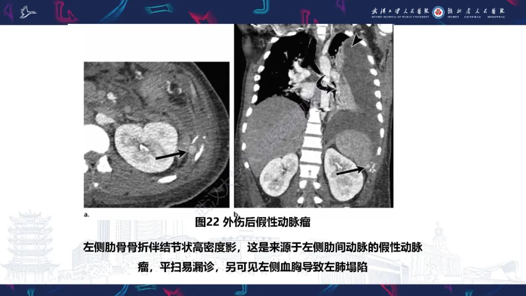 影像PPT - 【PPT】肋骨病变影像诊断-20