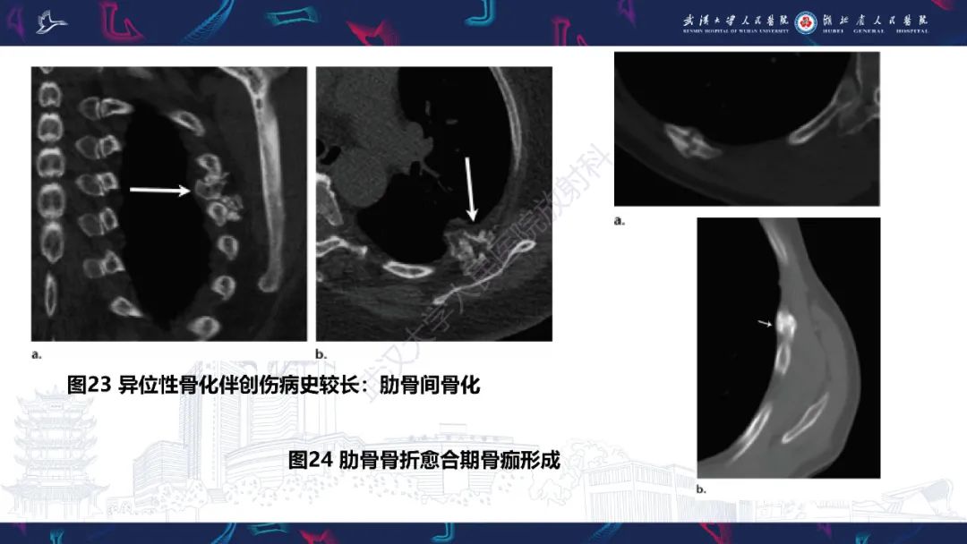 影像PPT - 【PPT】肋骨病变影像诊断-22