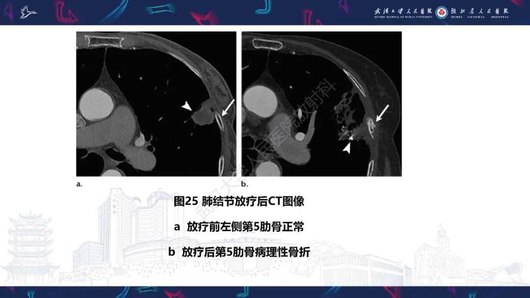 影像PPT - 【PPT】肋骨病变影像诊断-23