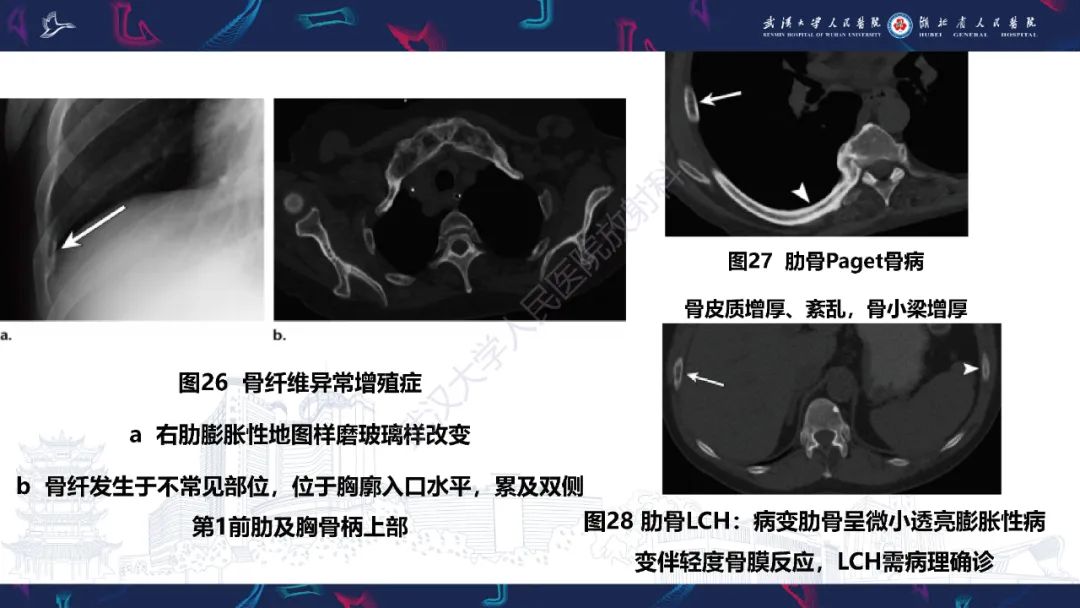 影像PPT - 【PPT】肋骨病变影像诊断-27