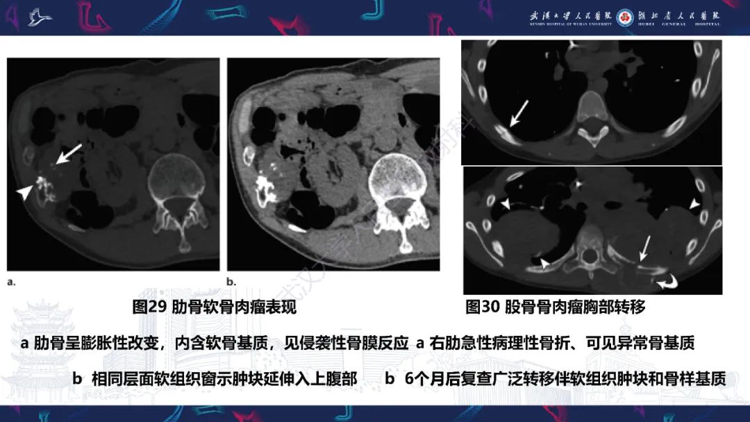 影像PPT - 【PPT】肋骨病变影像诊断-29