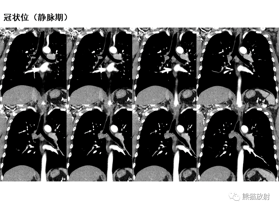 影像PPT - 【病例】支气管粘液表皮样癌2例CT影像-9