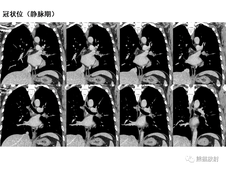 影像PPT - 【病例】支气管粘液表皮样癌2例CT影像-20