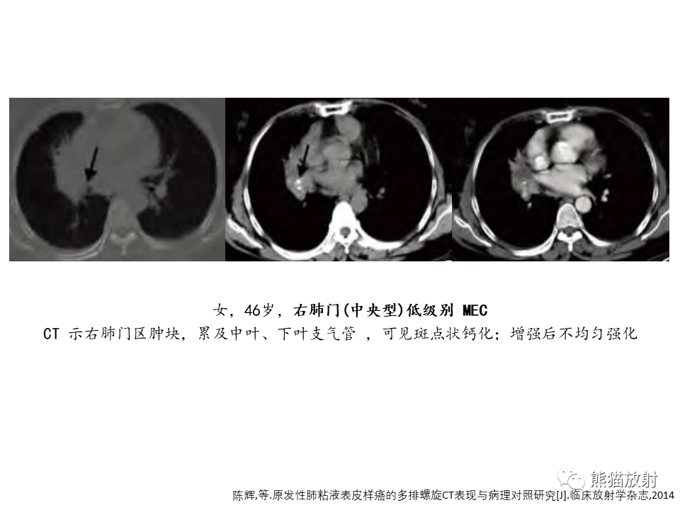 影像PPT - 【病例】支气管粘液表皮样癌2例CT影像-31