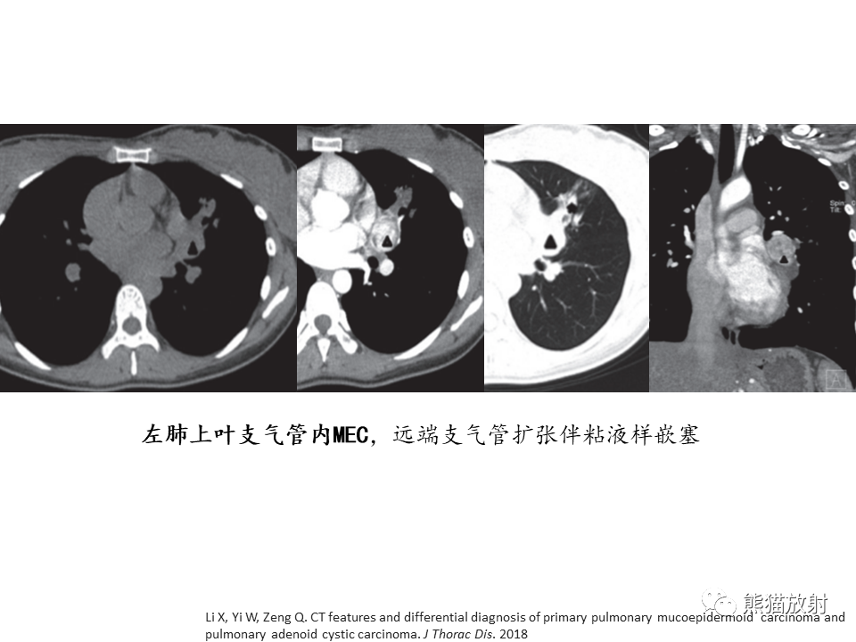 影像PPT - 【病例】支气管粘液表皮样癌2例CT影像-32